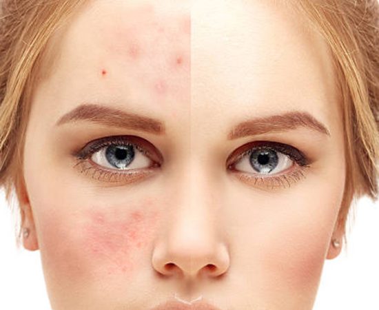 Rosacea_BascoVidales